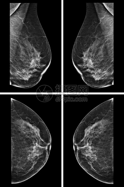 女乳房的侧位乳房X线照片在更高的放大倍数下图片