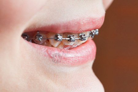 正畸治疗前上颌牙齿上的牙套关闭图片