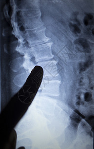 X射线整形医疗创伤科医院诊所对脊椎后部下疼痛损伤图片