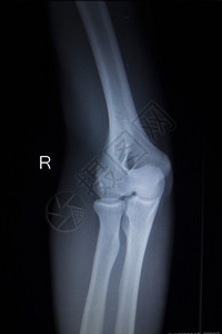 X射线整形医疗创伤医院诊所对痛苦的网球手肘损伤进图片