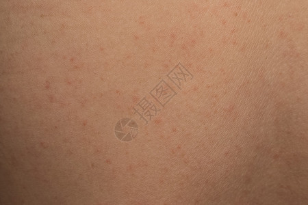 患者的过敏皮疹炎肤纹理图片