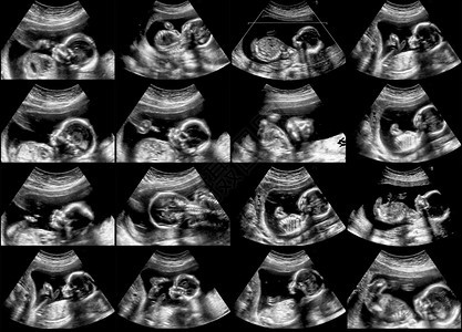 超声胎儿扫描的集合图片