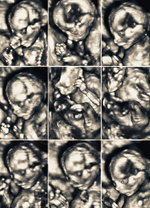 子宫内一个小胎儿的超声波收图片