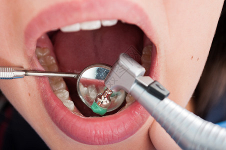牙科专业人员用牙镜刷牙的组合图片