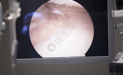 剖析手术屏幕显示膝部骨髓膜外科手术中的动脉镜照相机照片图片