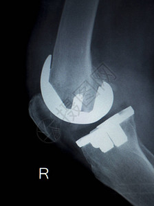 骨科膝关节半月板韧带肌腱和软骨损伤钛现代金属植入物图片