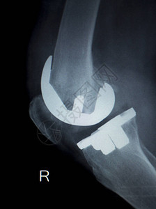 骨科膝关节半月板韧带肌腱和软骨损伤钛现代金属植入物背景图片
