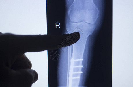 关节炎和关节疼痛患者的膝盖被植入后会痛图片