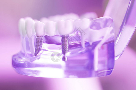 牙齿假牙口香糖根教授学生模型用钛金属螺丝植入图片
