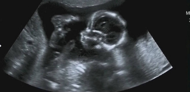 意大利实验室第四个月胎儿超声波谱学图片