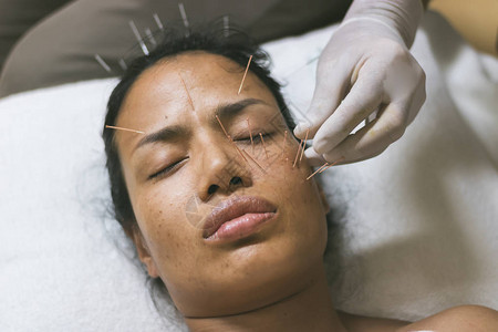 亚洲女40岁针灸面部保持健康和皮肤是健康图片