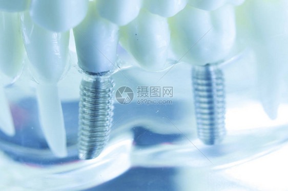 牙科钛美学正畸牙种植体在牙医口腔牙齿模图片