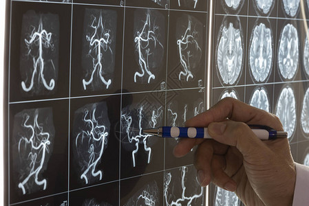 医生在灯箱上展示人脑MRI图片