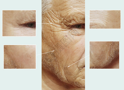 老人手术前后脸上的皱纹图片