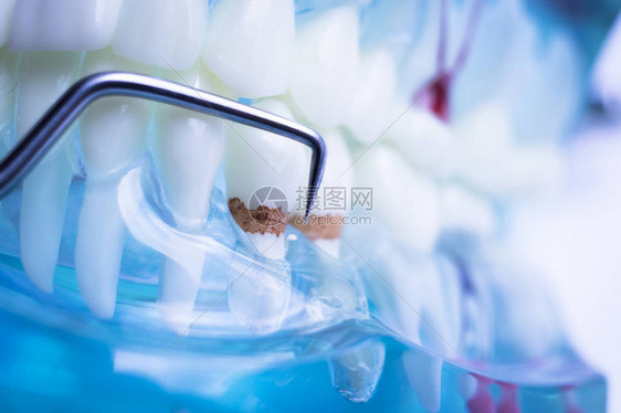 牙科医生用钛金属牙摘器清洗牙齿以除图片
