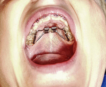 palatal扩展长牙上的病人儿童初图片素材