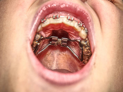 小男孩嘴里的牙套牙齿上戴着牙套的少年带牙套的牙齿宏观照图片