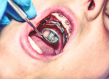 检查或治疗期间有牙套的病人牙科镜牙医图片