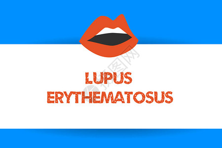 LupusErythematosus商业照片显示自发免疫疾病引发的炎症图片