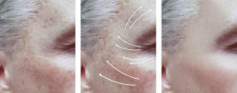 男人脸上的皱纹在程序前后和在图片