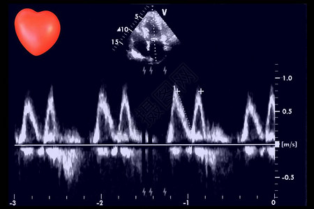 超声波图像和小心脏回声心动机屏幕图片
