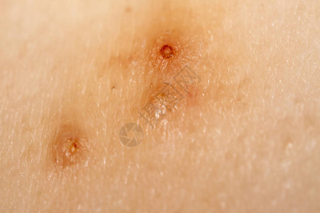 MolluscumContagiosum附图片