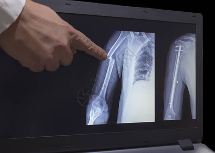 在监视器屏幕上显示手骨折的X光片图片