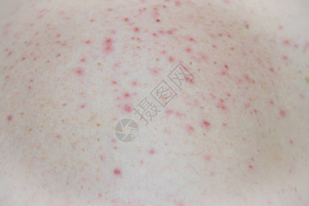 问题皮肤皮肤上的粉刺油问题皮背景图片