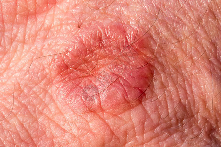 人类手有皮疹乳色瘤背景图片