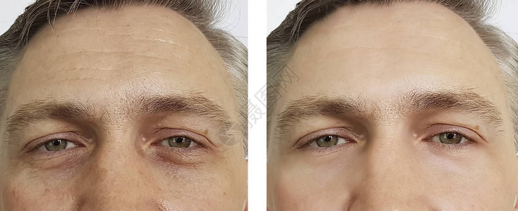 治疗前后男眼部皱纹图片