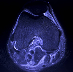 磁共振成像MRI膝盖后部角中枢断裂的眼泪图片