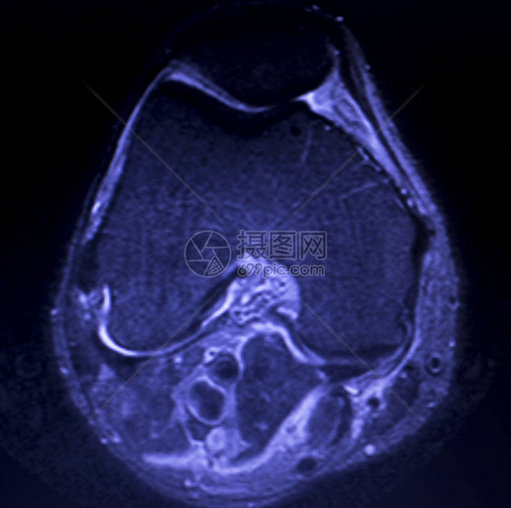 磁共振成像MRI膝盖后部角中枢断裂的眼泪图片