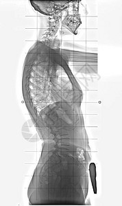 人体从胸部到骨盆完整的脊椎基磷和发病的图片