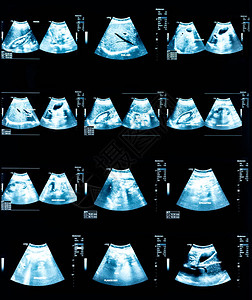 腹部的回音图像图片