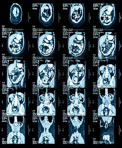 胸部和腹部磁共振图图片