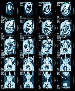 胸部和腹部磁共振图图片