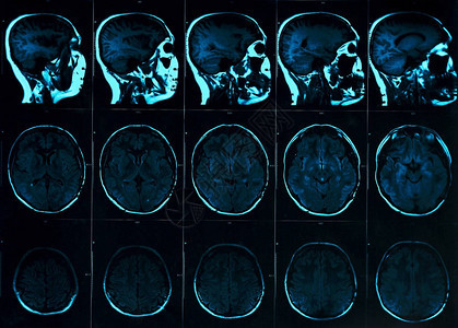 用头骨对大脑进行磁共振扫描图片