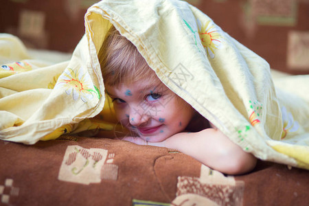 患水痘的孩子躺在床上孩子的头图片