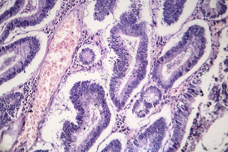 肠道腺瘤轻显微摄影显微镜下图片