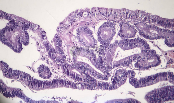 肠道腺瘤轻显微摄影显微镜下图片