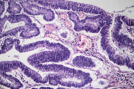 肠道腺瘤轻显微摄影显微镜下图片
