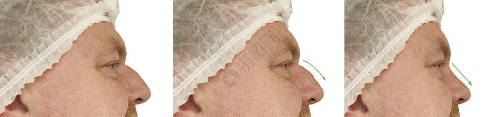 手术前后的人工鼻图片