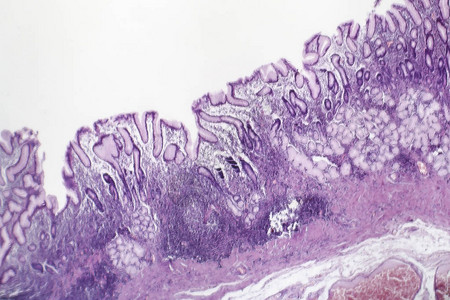 慢浅表胃炎的组织病理学图片