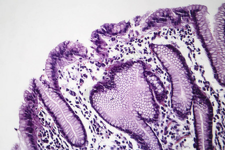 慢浅表胃炎的组织病理学图片