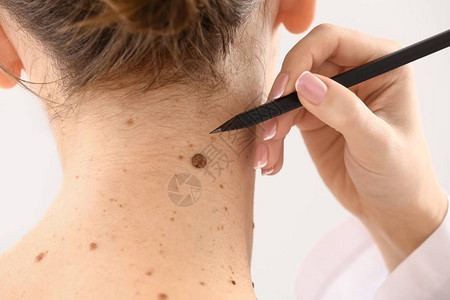 皮肤学家对病人皮肤施以印记在摩尔图片