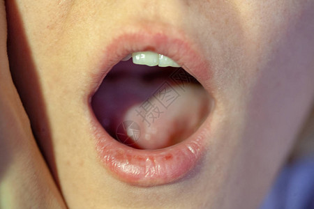 口腔内喉咙痛特写视图体检咽和扁桃体喉咙里有水泡喉咙舌图片