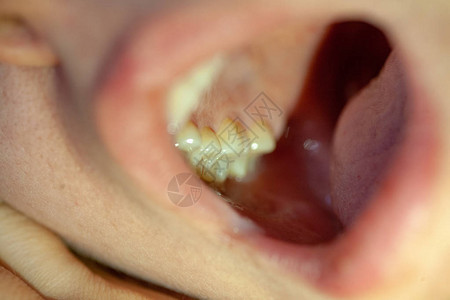 龋齿牙科诊所牙科治疗的概念图片