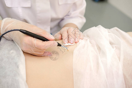 从女患者的胃中去除胎记的医学治疗女皮肤科医生使用电烙术去除腹部痣无线电图片