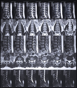 腰椎磁共振断层扫描图片