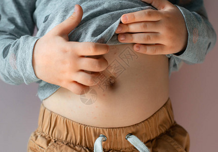 水痘宝孩子身上的水痘带状疱疹或疥疮皮肤病学的概念宝的肚子上有斑点特写抓图片